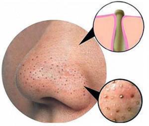 Simple home remedies to get rid of blackheads and whiteheads
