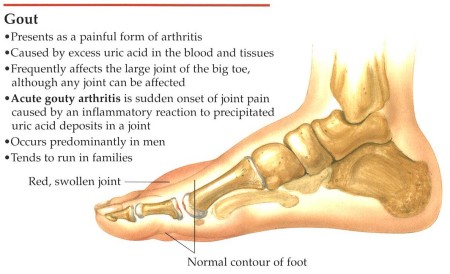 HOME REMEDIES FOR GOUTY ARTHRITIS ( High Uric Acid )